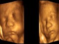 ultrasound 3d 4d