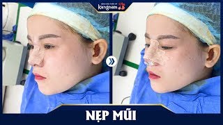 Nẹp mũi sau phẫu thuật cho em gái xinh xắn tại Kangnam