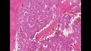 Histopathology Ovary--Granulosa Cell Tumor