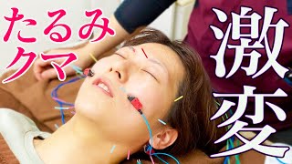 美容鍼 効果美容鍼効果で視聴者さんのお悩み速攻解決 .Hakadoru