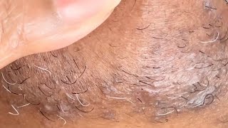 My Weekly Chin Hair Removal