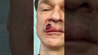 Skin Cancer Case Study Basal Cell Carcinoma Syndrome