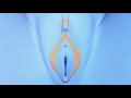 Labiaplasty Procedure explained video by Dr  Mark Lowney