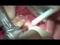 EXPLICIT - Dental implant placement with Immediate Temporary Crown
