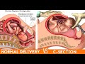 Medical Animation: Cesarean Delivery