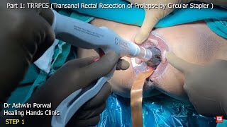 Part 1 : Rectal Prolapse with Anal Incontinence cured by Stapler TRRPCS & Thiers