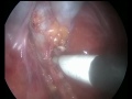 21-5-11-Single Incision Laparoscopic Chollycysectomy