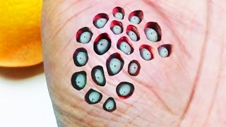 паразиты под кожей человека симптомы паразиты под кожей человека симптомы