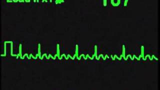 Atrial Flutter 31 - Ecg Simulator - Arrhythmia Simulator