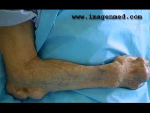 La osteocondrosis koreshkovyy el síndrome que este tal
