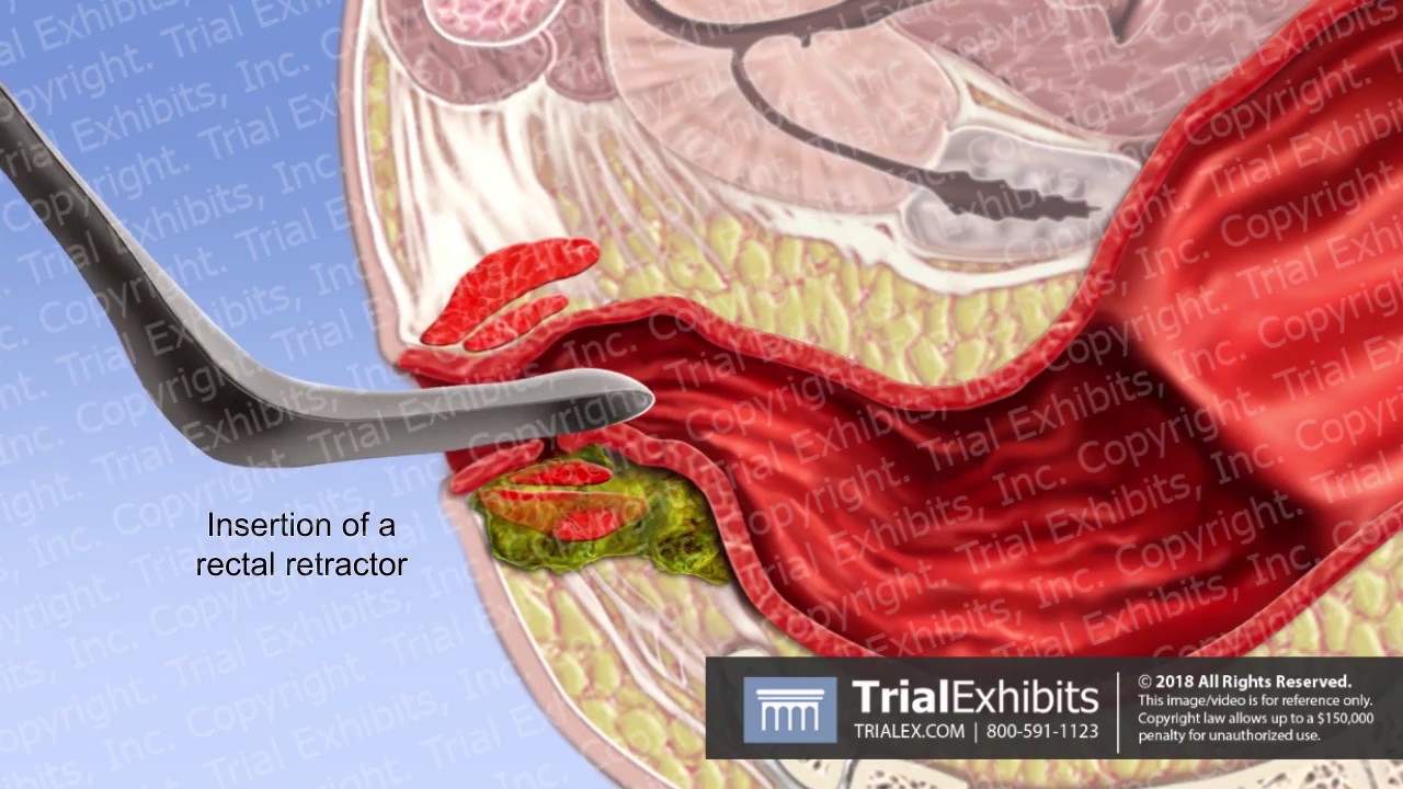 Anus fistula in painful repertory