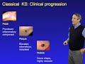 Don Ganem Part 1 Kaposis Sarcoma: The Disease