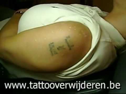 Laser Tattoo removal treatment usually only takes a few minutes, 