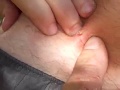 blackhead pimple punto negro extracted