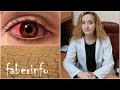 Офтальмолог про ВРЕД капель Визин и КРАСНЫЕ ГЛАЗА / Синдром сухого глаза /faberinfo