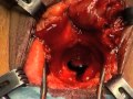 Dr. Javier Machuca - Uretroplastia Traumática Bulbo-Prostática