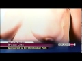 Breast Lift Mobile Alabama with Dr. Christopher Park