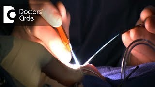 Cost For Treatment Of Pearly Penile Papules And Causes Of Scarring After Treatment - Dr. Nischal K