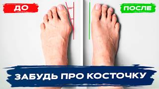 Эти 2 Схемы Помогут Убрать Вальгус И Косточку На Большом Пальце Ноги Без Операции