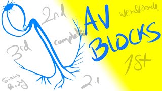 AV Blocks - 1st, 2nd and 3rd Degrees - Dr Jamal USMLE