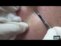 Back Blackheads From Heaven Back Blackheads From Heaven