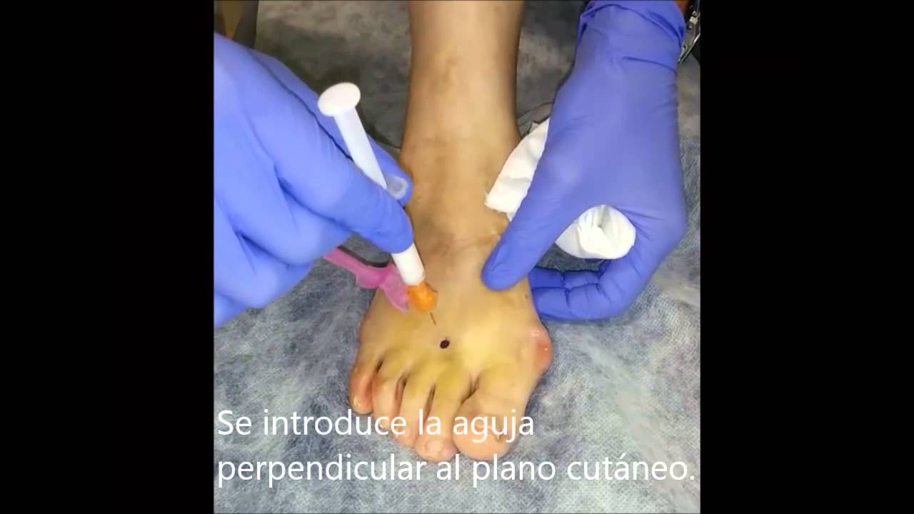 plantar neuroma