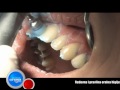 Izbjeljivanje zuba (koliko traje tretman?)