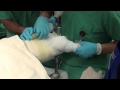 How is a child fitted with a Hip Spica Cast How is a child fitted with a Hip Spica Cast