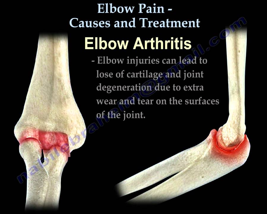 ELBOW PAIN CAUSES AND TREATMENT - Everything You Need To Know - Dr