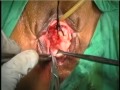 vaginal hysterectomy,previous Fothergill's repair ,prolapse uterus, dr c v hegde ,mumbai ,india.wmv