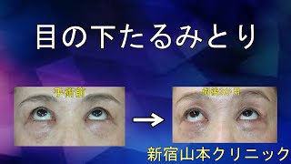 ☆目の下リフトアップ☆ アンチエイジングで若返り