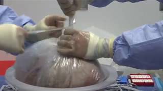 Ex Vivo Lung Perfusion In Action And By The Numbers