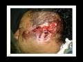 LESION GRAVE DE OREJA