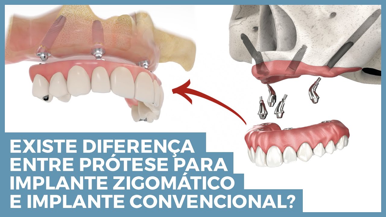 Qual a diferença da prótese de implante zigomático e implante convencional?