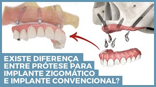 Qual a diferença da prótese de implante zigomático e implante convencional?
