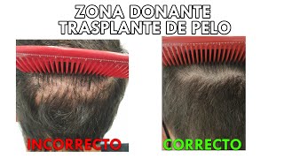 ¿Te vas a injertar pelo? Aprende esto sobre tu zona donante