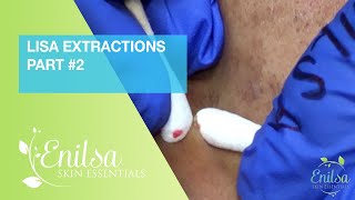 Lisa Extractions Part 2 Lisa Extractions Part 2