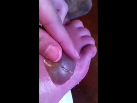 are extra tattoo laser removal popping blister from foot tattoo