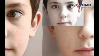 Penyebab Dan Cara Mengatasi Strabismus Atau Mata Juling