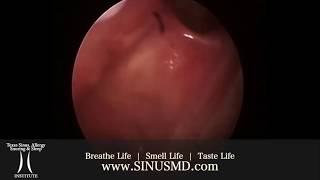 WATCH DR. KHETARPAL SPEAK WITH A PATIENT ABOUT NASAL POLYPS