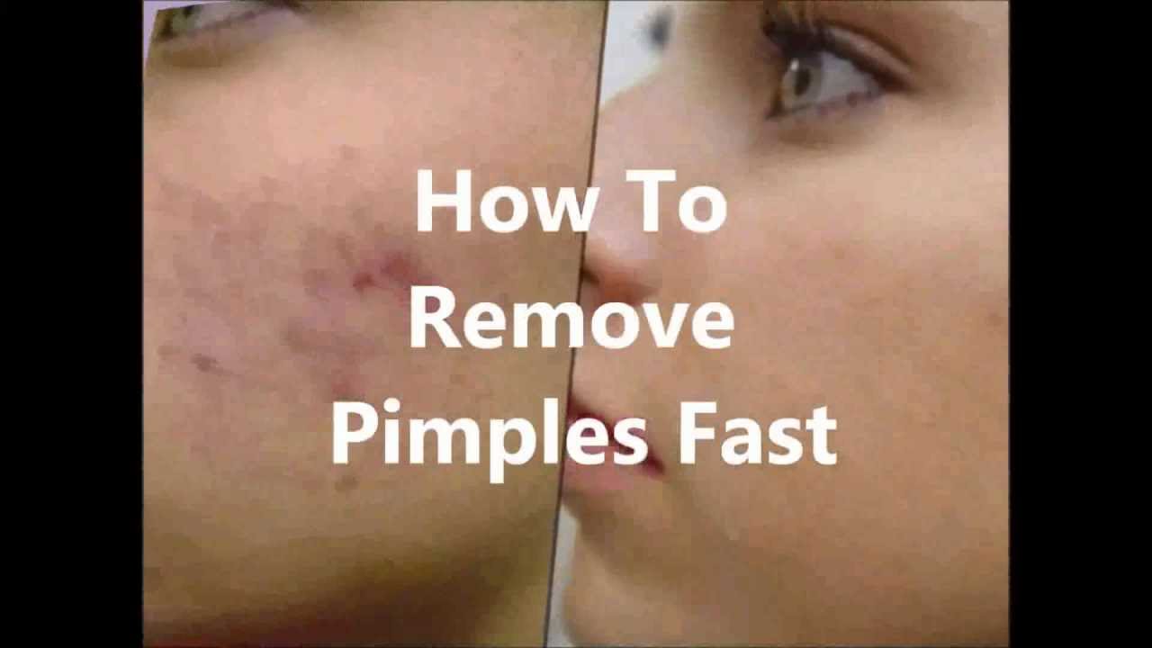 How To Remove Pimples Fast [99% Working! No Drug!!!] - YouTube