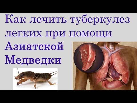 Как вылечить туберкулез домашних условиях Как вылечить туберкулез домашних условиях