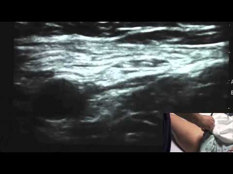 Ultrasound Guided Femoral Nerve Block - http://www.SsraOnlineCme.com