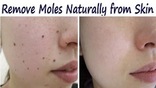 त्वचा से जिद्दी तिल, मस्से हटाने के रामबाण घरेलू उपाय – Remove Moles Naturally from Skin