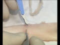 Anastomosis