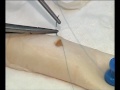 Anastomosis