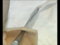 Anastomosis