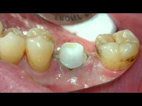 Los Angeles Implant Dentist 8-13-s