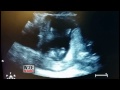 Mom-To-Be Says Baby Didn't Clap to Music During Ultrasound