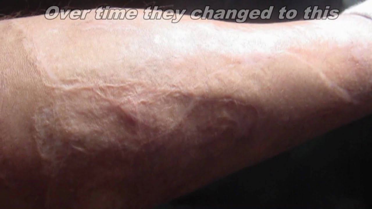 BURN SCARS - a photo montage showing my 3rd degree burn ...